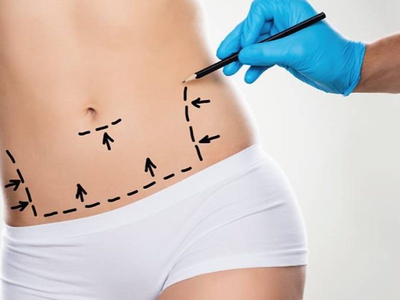 Abdominoplastia
