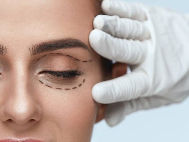 Blefaroplastia (Cirurgia das Pálpebras)