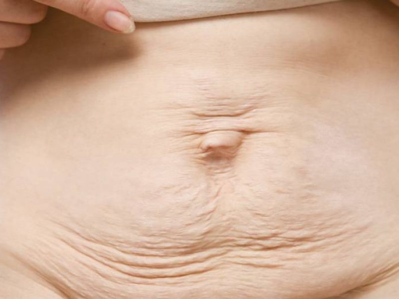 Cirurgia pós-Bariátrica (Bodylifting)