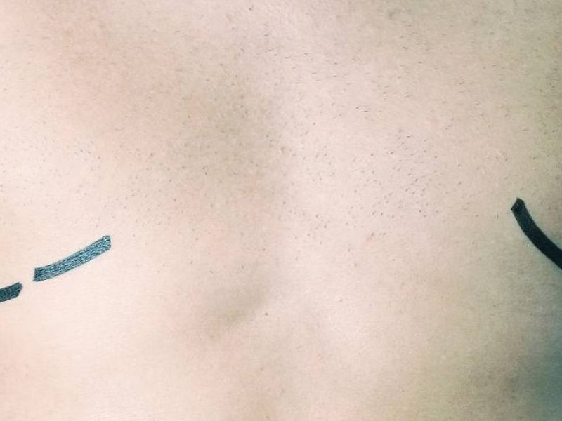 Correção de Ginecomastia