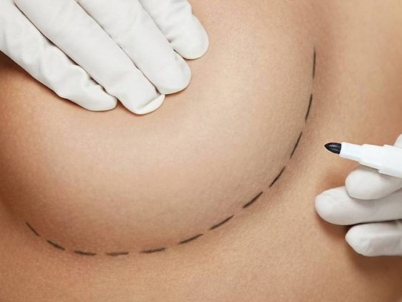 Mamoplastia de Aumento (Prótese de Silicone)