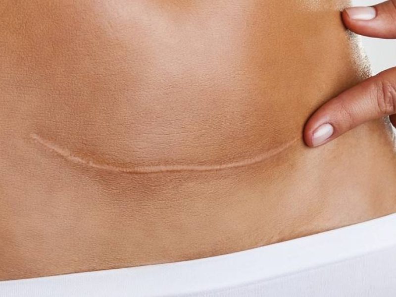 Tratamento de Queloides, Cicatrizes Hipertróficas e Cicatrizes em Geral